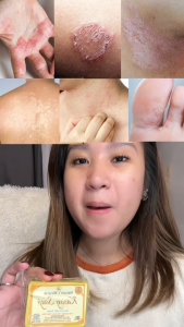 Top Seller KASOY SOAP ORIGINAL by NATURES MIRACLE | FDA APPROVED | Nourishes and Moisturizes Skin | Itch-free Skin | Helps Acne Pimples Dry and Rough Skin Dark Spots and Oily Thick Pores | Wartless Skin | Sabon para sa Kati-kati sa Balat An-an at Buni