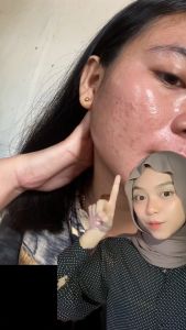 Krim Malam Overnight Acne Prone Cream dr Netha - Solusi Lengkap untuk Jerawat dan Kulit Berminyak