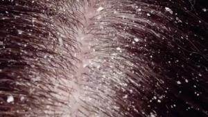 Xịt Dưỡng Da Đầu PURC - Kiểm Soát Dầu Chống Gàu Giảm Ngứa Làm Sạch Sâu Cho Tóc Khỏe Mạnh 60ML