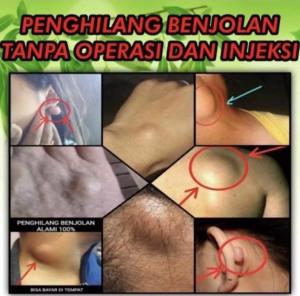 PENGHILANG BENJOLAN TERAMPUH - Oilife Obat Penghilang Benjolan Obat Wasir Dan Embeien Obat Benjolan Ampuh Obat Benjolan Di Seluruh Tubuh Obat Benjolan Di Leher Obat Benjolan Di Tangan Obat Kista Obat Gondok Obat Lipoma yg Ampuh