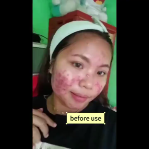 Krim Penghilang Jerawat Herbal Krim Penghilang Jerawat Krim Perawatan Kulit Pemutih Gel Wajah Pelembap Kontrol Minyak Jerawat 50g