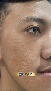 dr. Fay Cream Penghilang Flek Hitam dan Bekas Jerawat Resmi BPOM