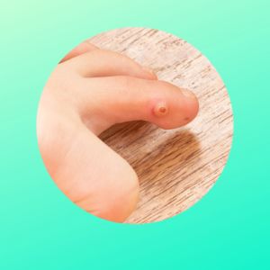 Carnation Corn Caps Plasters 5S - Clinically Proven for Corn Removal with Salicylic Acid - Soft Felt Corn Ring for Pressure Relief