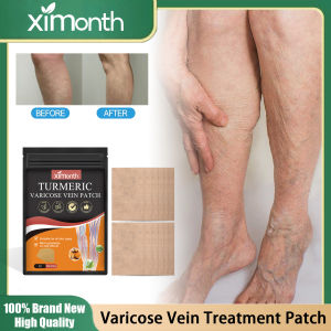 Varicose Vein Treatment Patch Soothe Calves Heaviness Edema Prevent Vasculitis Phlebitis Improve Leg Spider Vein Removal Plaster