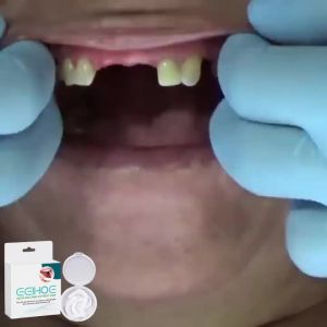 EELHOE | Eelhoe Adjustable Snap-On Teeth Veneers Cover up Plaque Soft Comfortable Reusable Repairing Gap Upper Lower Jaw Temporary Crown