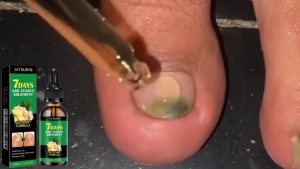 Jaysuing 7days Nail Fungus Treatment Fungal Onychomycosis Paronychia Broken Toe Nail Repair Foot Toe Nail Fungus Removal Serum 30ml