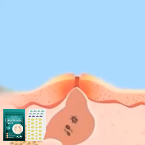 【100%ORIGINAL】112 Patches Eelhoe Star Pimple Patch Acne Colorful Invisible Care Stickers Makeup Removal Face Spot Beauty Tools Acne Concealer