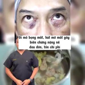 Kem OpenEyes xóa tan bọng mắt thâm quầng nhập khẩu chính hãng 15gr