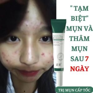 Kem chấm mụn SẠCH MỤN CẤP TỐC HẾT MỤN 100% AXIT SALICYLIC hiệu quả hết mụn siêu tốc ngừa sẹo thâm 20g