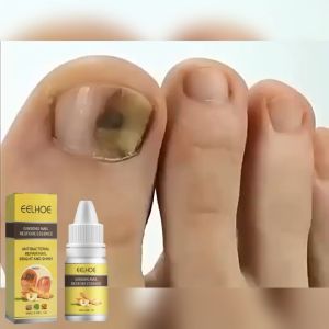 Eelhoe Ginseng Nail Restore Essence Gray Nail Removing Essence Thickening Nail Repair Nutrition Paronychia Treatment Anti Fungal Nail Solution Hand Foot Skin Care 10ml