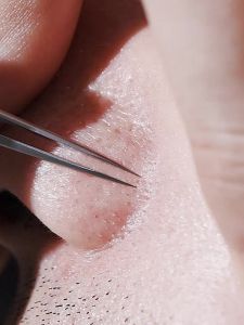 German Ultra-fine No. 5 Cell Pimples Blackhead Clip Tweezers Beauty Salon Special Scraping & Closing Artifact Acne Needle Tool