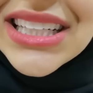 Snap On Smile Veneer Gigi Palsu: Solusi Penutup Ompong & Gingsul