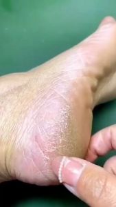 Kem Ngăn Ngừa Và Hồi Phục Nứt Nẻ Gót Chân Kpem Nga 50ml