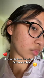 Differin Acne Gel 0.1% | Fights Breakouts& Soothes Skin-15g