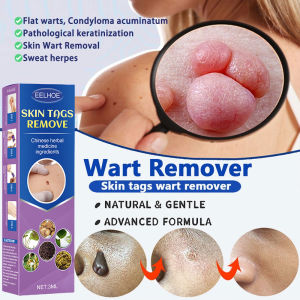 Warts Mole Remover Serum Pen Original Skin Tag Wart Remover Cream Original Warts Remover Effective