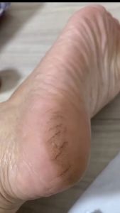 BPOM Tumitku: Solusi Kaki Kalus Pecah & Kapalan Kering