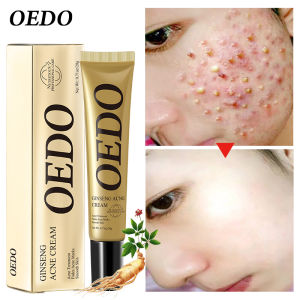 OEDO Kem mụn nhân sâm chiết xuất thực vật giúp khử chăm sóc da mặt mụn và làm trắng trọng lượng 20g - INTL