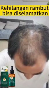 NATURAL ESSENCE GINGER SERUM PENUMBUH RAMBUT ANTI RONTOK ANTI KETOMBE Serum Penumbuh Rambut
