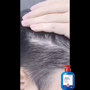 Dầu gội trị gàu dầu gội selenium disulfide dầu gội chăm sóc da đầu chống ngứa 300ml tóc dầu kiểm soát dầu mềm mượt