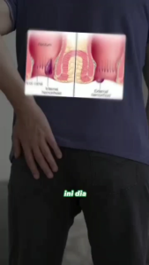 Kapsul Daun Ungu Herbal Wasir Ambeien – Obat Alami Tanpa Efek Samping