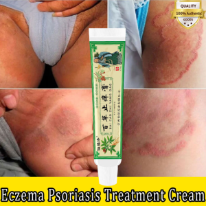 Eczema Cream Herbal Anti Itch Cream sterilize and relieve itching Psoriasis Cream Relieves itchy inner thighs