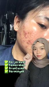 Paket Acne Series dr. Netha BPOM - Hemat dan Efektif Untuk Merawat Kulit Berjerawat