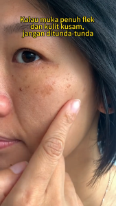 [BPOM] YOUBUY Whitening Blemish Flek Hitam Penghilang Flek Hitam Original Cream Anti Freckle Salep Melasma Dark Spot Pemutih Noda Hitam 20g