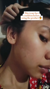 [SG INSTOCK] Himalayan Healing Soap - For Psoriasis Eczema Scaling Acne by Bella Amore Skin 130g