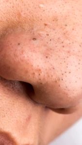 PERFECT WHITE Arbutin AHA Peeling Serum | Serum Eksfoliasi Mencerahkan Kulit Kusam