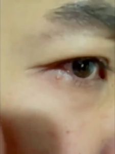 Kem bơ Mụn Thịt Dư Yaqinuo/giảm túi mắt