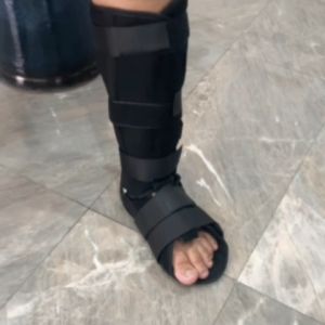 เฝือกอ่อนขา ข้อเท้า เฝือกอ่อน หลังจากผ่าตัด ผ่าตัด บันเทาอาการเจ็บปวด น่อง ขา น่องขา และ รองเท้าหุ้มเฝือก ช่วยให้เดินได้สะดวก  by.VIP25