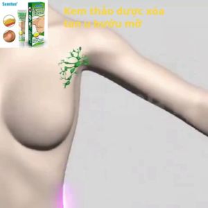 Kem da liễu bôi Tan U Mỡ Bướu Mỡ Mỡ Thừa Bụng Mỡ Thừa Đùi ... thành phần thảo dược an toàn - Cam kết hiệu quả