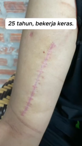 Scar Removal Cream Actiscar 20g fades keloids acne scars and dark scars.