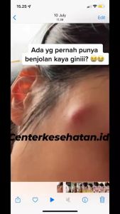CHITA OIL Asli Original 100% | Minyak Oles Benjolan | Benjolan Di Tangan Benjolan di leher Benjolan Di Payudara Ambien Lipoma Uci-Uci Kelenjar Getah Bening Menghilangkan Segala Macam Jenis Benjolan Pada Tubuh | Ampuh Dalam 5 Hari