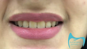 Snap On Tooth Cover False Teeth Upper & Lower Dental Veneers Dentures / Gigi Palsu Viral