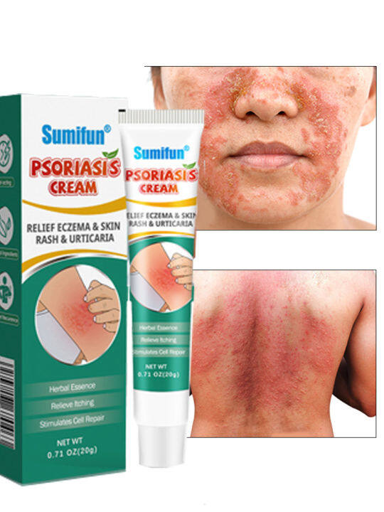 Psoriasis Eczema Cream Anti-itching Antibacterial Atoderma Ointment Herbal Dermatitis Cream 20g Eczema Treatment Cream gamot sa kati kati sa balat buni Psoriasis Treatment Cream Eczema Ointment for Itchy Skin and Allergy Antibacterial Fungisol Antifungal