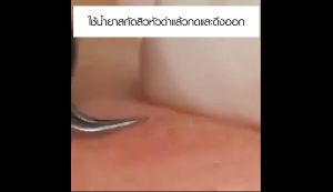 Bigmall Acne Tools 4-ชิ้น เครื่องมือกดสิว ชุดกดสิว สแตนเลส พร้อมกล่อง No.Y1770