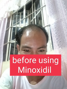 60ML MINOXIDIL STRANDS HAIR REGROWTH TREATMENT 6% MINOXIDIL TOPICAL HAIR AND SCALP SOLUTION STIMULATES HAIR FOLLICLES PROVEN TO REGROW HAIR BEST ANTI HAIR LOSS ANTI BALDNESS ANTI HAIR THINNING ALOPECIA TREATMENT FOR MEN AND WOMEN
