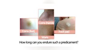 Feet Corns/ Warts Removal Patch Pain Relief Remover Feet Callus Remove Soften Skin Cutin Sticker Medical Plaster Feet Care Tool Foot Patch warts removal patches feet corns warts removal patch  10Pcs