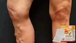 Miếng dán điều trị giãn tĩnh mạch cho giãn tĩnh mạch viêm mạch viêm tĩnh mạch chân mạng nhện miếng dán y tế loại bỏ viêm mạch