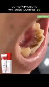 【BUY 1 TAKE 1】Probiotic Caries Toothpaste SP-4 Whitening Tooth Decay Repair Paste Teeth Cleaner Plaque Remover Effectively Cleans and Whitens Teeth and Helps Reduce Tooth Stains Bright Teeth