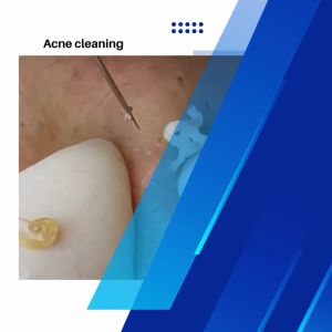 Alat Pembersih Komedo Jerawat Blackhead 3 PCS