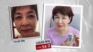 1 แถม 1 Barcony ครีมโบท็อกซ์หน้าตึง กระชับ เกาหลี 1 กระปุก แถมฟรี เซรั่มฟิลเลอร์หน้าอิ่มฟู เกาหลี 1 ขวด