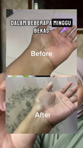 TERBATAS BELI 2 DAPAT 3 Taboya Zhang Ru Cream | Krim Penghilang Bekas Luka ORIGINAL