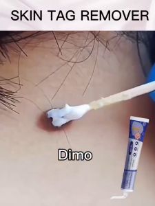 Wart Remover Salep Skin Tag Remover Obat Penghilang Kutil: Krim Penghilang Kutil Mudah Dibawa Untuk Semua Kulit