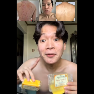 Natures Miracle Organic Kasoy Soap Germicidal Anti-Bacterial Anti-Itch Anti-Odor Tea Tree Oil for Acne Psoriasis Eczema Body Odor Ringworm An-an/Tinea