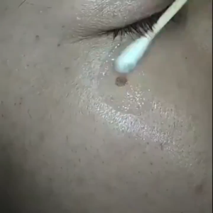 Freckle serum for Whitening and freckle removal chloasma age spots Hereditary spots Pigmented spots sunspot Herbal Whitening and Melasma Removal 100 g