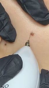 [Combo 3 món] Máy Đốt Nốt Ruồi + Kem Ủ Tê Bọ Cạp + Gel Liền Sẹo Máy Đốt Mụn Thịt Tàn Nhang 9 Cấp Độ Có Đèn Chiếu Sáng Bút Đốt Nốt Ruồi Xóa Tàn Nhang