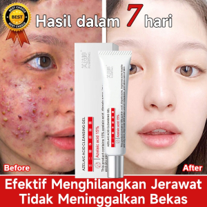 Penghilang Jerawat & Obat Jerawat 15g: Solusi Perawatan Kulit Wajah