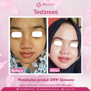 DRW SKINCARE PAKET OILY ACNE ABHA 3 KRIM JERAWAT PEMUTIH ACNE ORIGINAL 100%